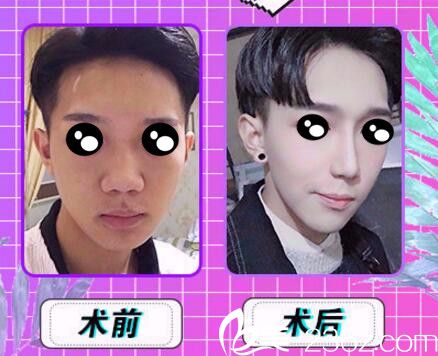 长沙协雅韩式芭比小翘鼻真人前后效果对比