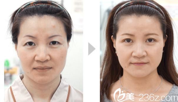 川崎整形医院开眼角+双眼皮手术1