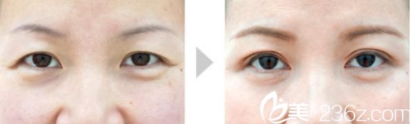 川崎整形医院开眼角+双眼皮手术2