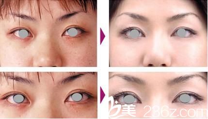  高牟礼双眼皮修复