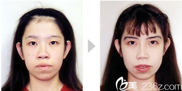 高牟礼隆鼻术 高牟礼隆鼻术