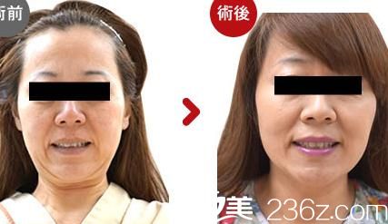 高牟礼线雕提升1 高牟礼线雕提升1