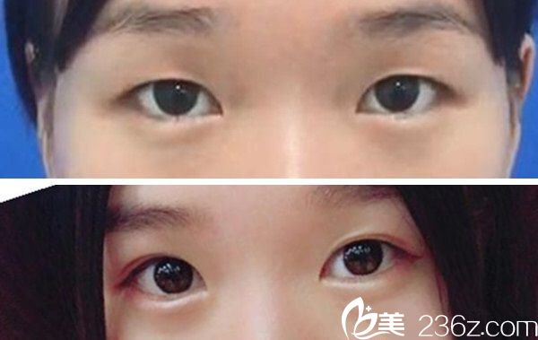 刘广志主任双眼皮手术案例