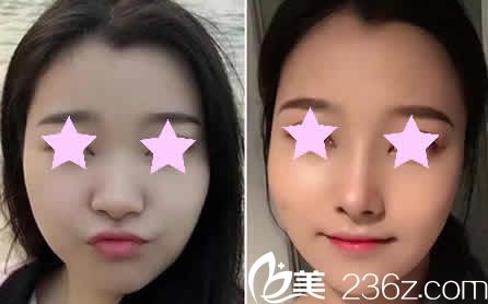 大同美神整形鼻综合术后15天效果图