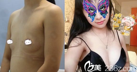 宁波建国整形假体隆胸2个月效果 宁波建国整形假体隆胸2个月效果