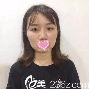 双眼皮修复术前照 双眼皮修复术前照