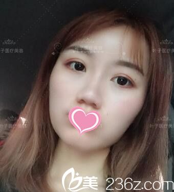 做双眼皮修复术后20天恢复效果 做双眼皮修复术后20天恢复效果