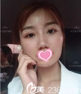 做双眼皮修复术后30天恢复程度 做双眼皮修复术后30天恢复程度