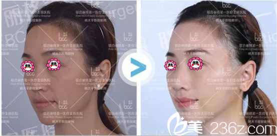 北京联合丽格杨大平微拉美复合提升术案例 北京联合丽格杨大平微拉美复合提升术案例