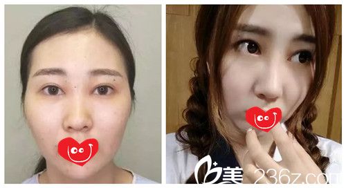 沧州静港硅胶隆鼻案例 沧州静港硅胶隆鼻案例