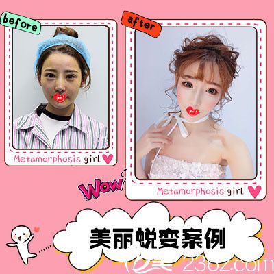 静港整形医院硅胶垫下巴案例 静港整形医院硅胶垫下巴案例