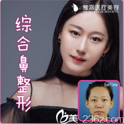 惠州雅涵医疗美容高山做的隆鼻案例对比图