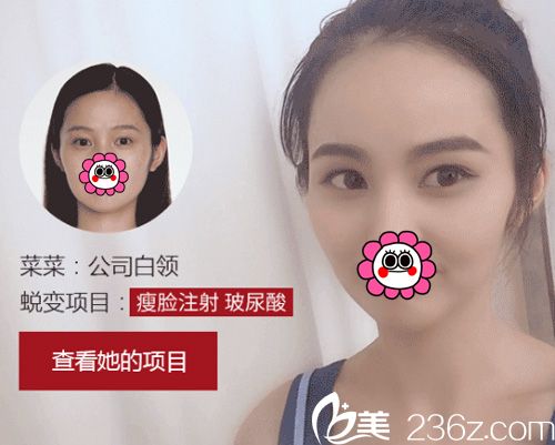 武汉艺星瘦脸案例 武汉艺星瘦脸案例