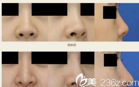 酒井直彦隆鼻术 酒井直彦隆鼻术