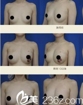 酒井直彦自体脂肪丰胸