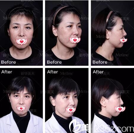 大连新华美天激光祛雀斑真人前后效果对比