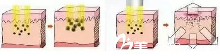 激光祛雀斑过程图解