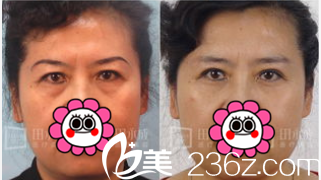 北京永成魅力医院眼袋失败修复多少钱？公布医院价格表和田永成祛眼袋案例