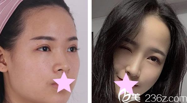 韩国TheOne整形方暖硕假体隆鼻+线雕隆鼻案例