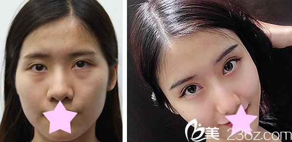 韩国TheOne整形金相耿自体脂肪面部填充前后效果对比图