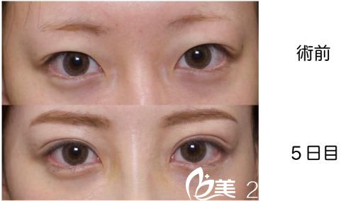 GL法埋设双眼皮 GL法埋设双眼皮
