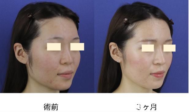 鼻中隔延长 鼻中隔延长