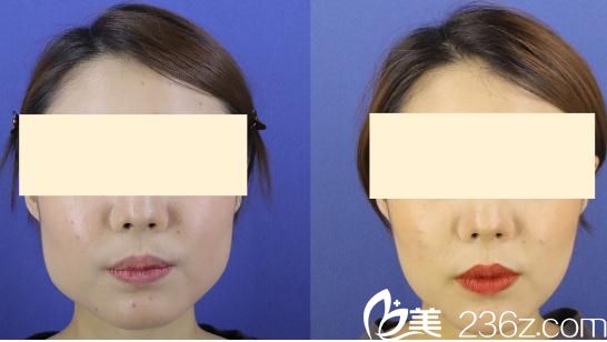 脸颊瘦脸除皱注射 脸颊瘦脸除皱注射