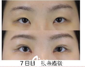 长濑大藏GL法埋设双眼皮 长濑大藏GL法埋设双眼皮