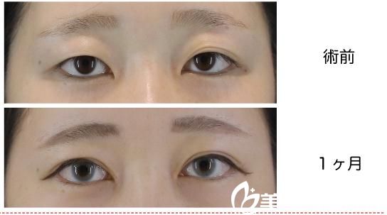 长濑大藏GL法埋设双眼皮 长濑大藏GL法埋设双眼皮