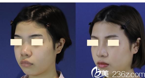 长濑大藏鼻中隔延长 长濑大藏鼻中隔延长