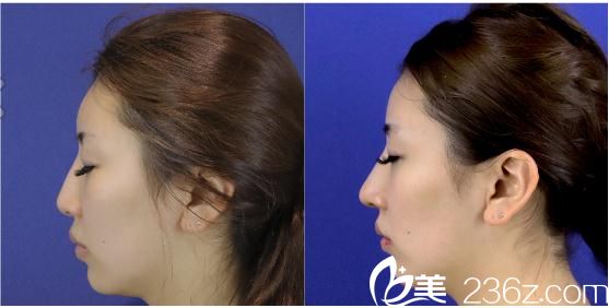 长濑大藏鼻中隔延长 长濑大藏鼻中隔延长