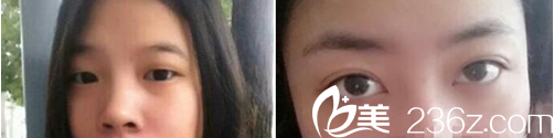 双眼皮案例 双眼皮案例