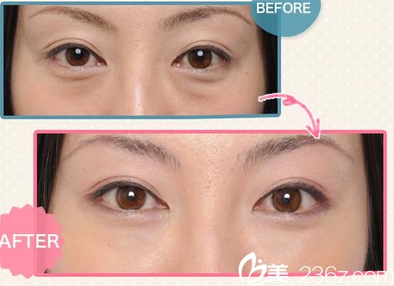 松仓美容外科&医疗spa医院玻尿酸注射 松仓美容外科&医疗spa医院玻尿酸注射