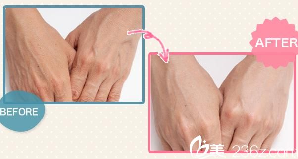 松仓美容外科&医疗spa医院玻尿酸注射 松仓美容外科&医疗spa医院玻尿酸注射