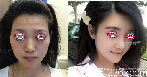 北京米扬丽格夏正义综合隆鼻自体脂肪面部填充案例