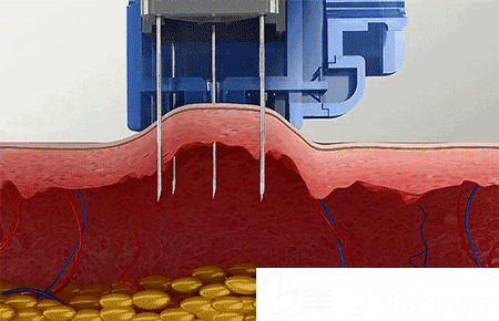 洛阳毛大夫注射