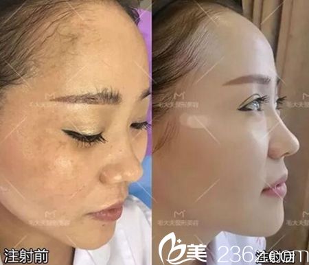 洛阳毛大夫注射案例