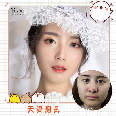 深圳yestar魏鑫铭做的鼻综合隆鼻子案例 深圳yestar魏鑫铭做的鼻综合隆鼻子案例