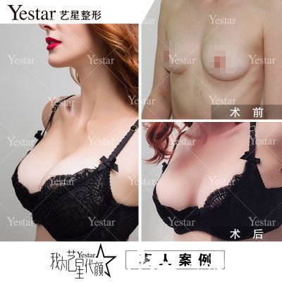 深圳艺星柯吟笑做的假体隆胸案例 深圳艺星柯吟笑做的假体隆胸案例