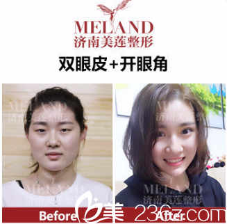 双眼皮效果展示