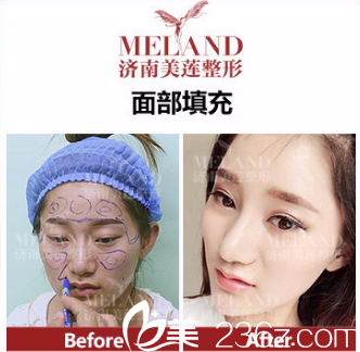 自体脂肪填充案例