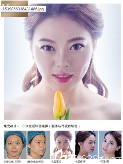 深圳yestar艺星整形魏鑫铭做的隆鼻子案例 深圳yestar艺星整形魏鑫铭做的隆鼻子案例