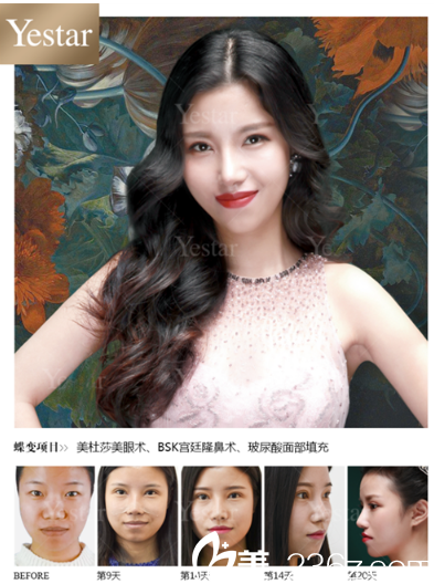 深圳yestar魏鑫铭做的美杜莎综合美眼双眼皮和隆鼻案例 深圳yestar魏鑫铭做的美杜莎综合美眼双眼皮和隆鼻案例