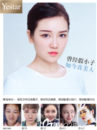 深圳艺星整形医院魏鑫铭医生双眼皮隆鼻案例 深圳艺星整形医院魏鑫铭医生双眼皮隆鼻案例