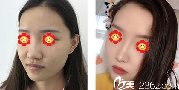 包头汝森杨子伟医生假体隆鼻+自体脂肪面部填充效果案例 包头汝森杨子伟医生假体隆鼻+自体脂肪面部填充效果案例