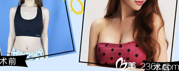 包头汝森假体隆胸+自体脂肪丰胸真人案例 包头汝森假体隆胸+自体脂肪丰胸真人案例