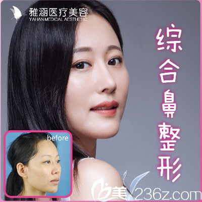 深圳雅涵隆鼻大王高山肋软骨鼻综合隆鼻子案例