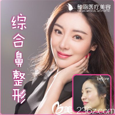 深圳雅涵高山做的鼻翼缩小案例