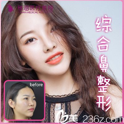 深圳雅涵隆鼻大王高山做的鼻综合隆鼻案例