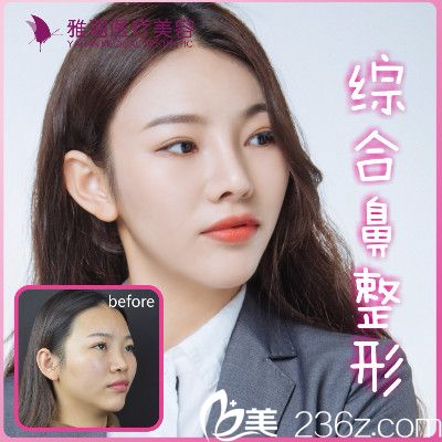 深圳雅涵高山做的膨体隆鼻案例对比图
